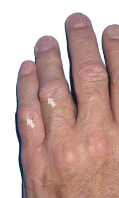 fingerknötchen-Polster = knuckle pads