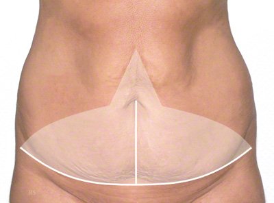 Erweiterte Bauchdeckenstraffung bzw. Abdominoplastik
