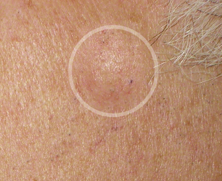 Grützbeutel Fotos Atherom | YUVEO Klinik