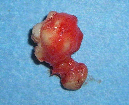 Epidermalzyste Behandlung Operation YUVEO Klinik