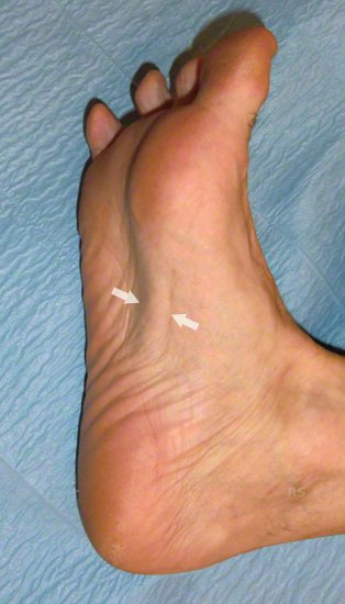 Morbus Ledderhose eine Plantarfibromatose
