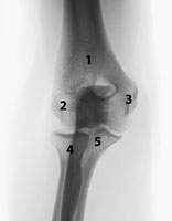 Ellenbogengelenk Röntgenbild mit Oberarmknochen Elle und Speiche