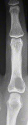 Enchondrom am Finger - Hand