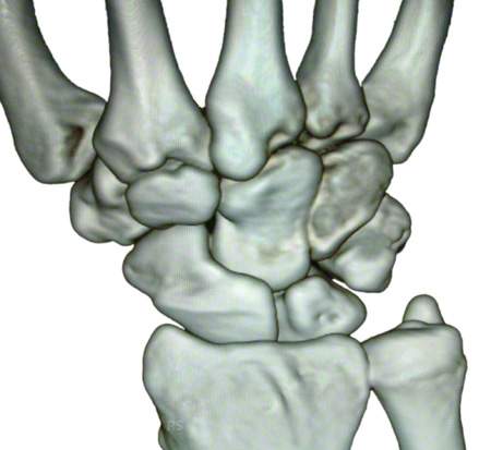 handgelenk-knochen - Handgelenksknochen - Handwurzelknochen