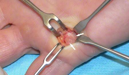 Ringbandganglion
