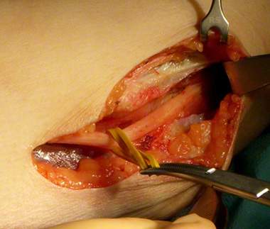 Operation bei sulcus-ulnaris-syndrom - Kubitaltunnelsyndrom
