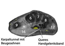 Handgelenksanatomie mit Handwurzelknochen Medianus Nervus und Sehnen