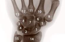 handgelenksknochen - Kahnbein, Mondbein, Schiffbein