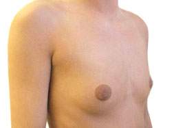 Die Mikromastie bedeutet eine zu kleine Anlage der Brust