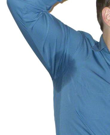 ausgeprägte Hyperhidrosis axillaris