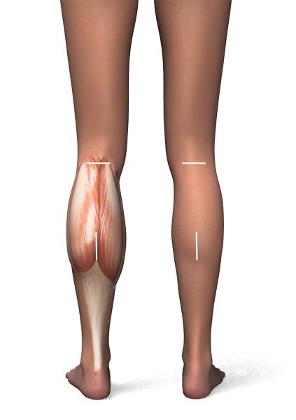 Waden-Op: Wadenverkleinerung durch Entfernung des M. gastrocnemius