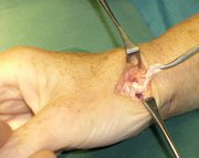 rhizarthrose-operation