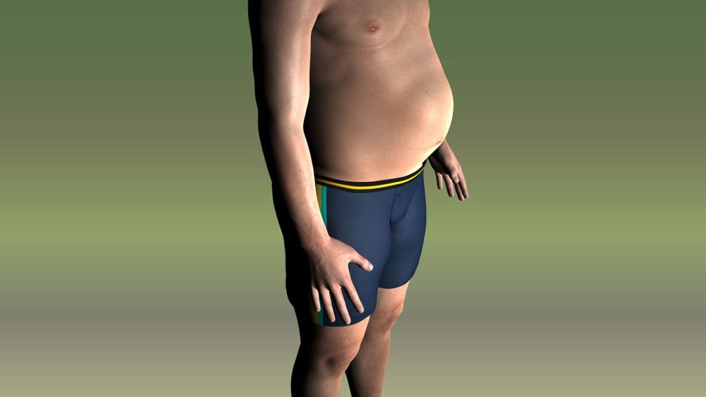 Bierbauch - YUVEO Klinik Bierbauch - YUVEO Klinik