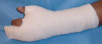 dupuytren gips 10313w yuveo