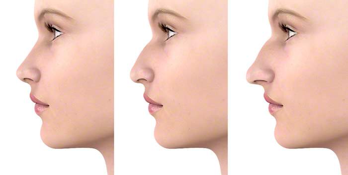 Grafisch dargestellt, sehen Sie, wie unterschiedlich ein Profil desselben Gesichts wirken kann – bei durchschnittlicher Nasenform und bei einer leichten und sehr stark ausgeprägten Lang-Höcker-Nase, auch Hakennase genannt.