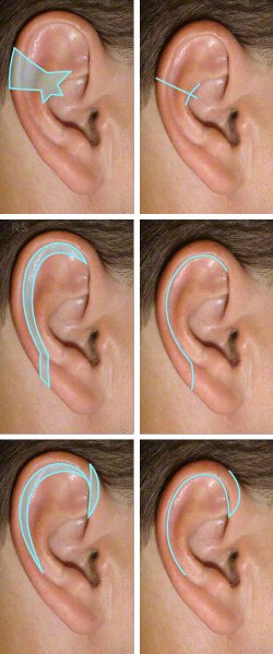 Ohrenverkleinerung
