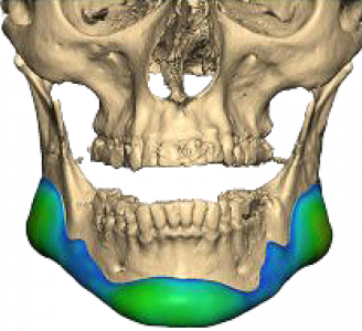 Unterkieferimplantat