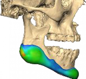 Unterkieferimplantat